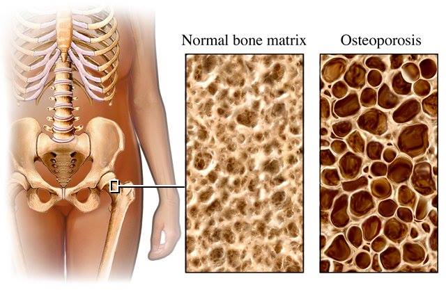 Prevenir la osteoporosis